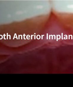 Classic Collection: Single Tooth Anterior Implants