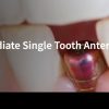 Classic Collection: Immediate Single Tooth Anterior Implants
