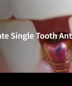 Classic Collection: Immediate Single Tooth Anterior Implants