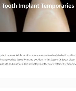 Classic Collection: Single Tooth Implant Temporaries