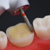 BAARD Overlay & Onlay Preparation Design (Dental Course)