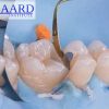 The Baard Biobases: Advanced Adhesive “Build Ups” & Deep Margin Elevation (Dental course)