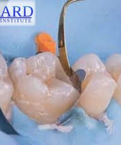 The Baard Biobases: Advanced Adhesive “Build Ups” & Deep Margin Elevation (Dental course)