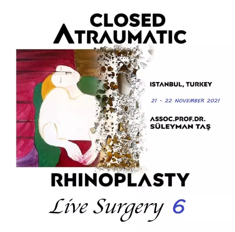 Closed Atraumatic Rhinoplasty Live Surgery DVD 6