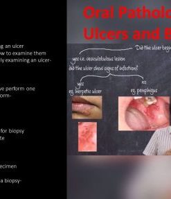 Ulcers and biopsy