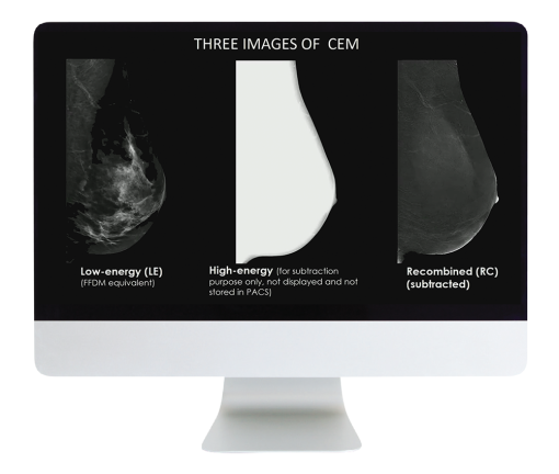 Contrast Enhanced Mammography: The Essentials and Beyond