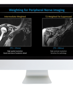 MR Neurography and NS-RADS: Assist Your Neuropathy and Pain Patients