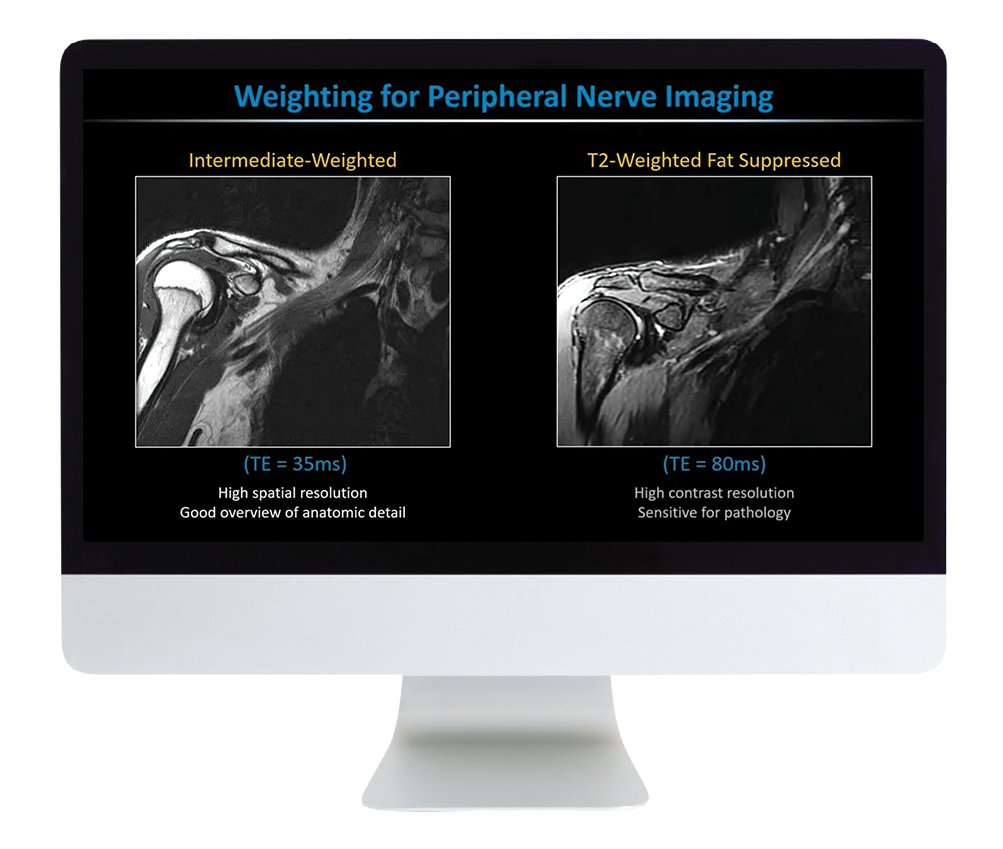 MR Neurography and NS-RADS: Assist Your Neuropathy and Pain Patients