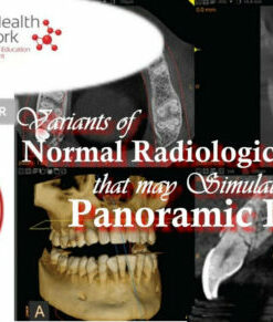 Variants of Normal Radiologic Anatomy that may Simulate Disease on Panoramic Images – Ernest Lam